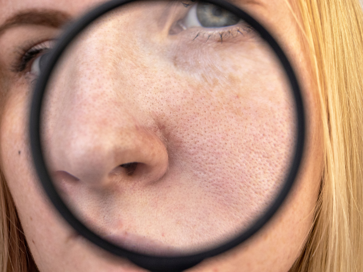 Poros Dilatados. Foto mostra mulher branca, ruiva com uma lupa sobre o rosto mostrando os poros mais dilatados.
