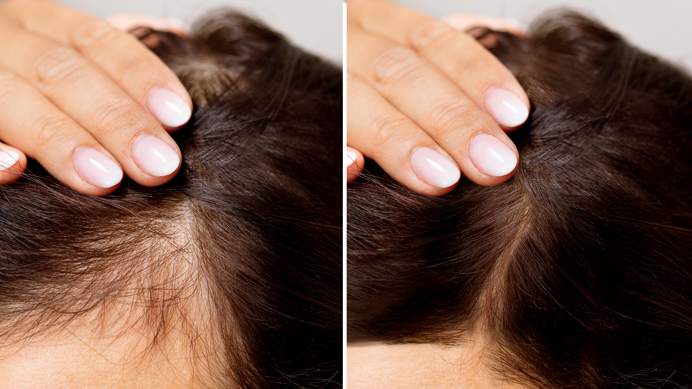 antes e depois de tratamento contra queda de cabelo